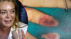 Lindsay Lohan zverejnila snímky, ako jej prišívali odseknutý prst