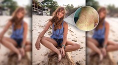 Alergia na prácu skutočne existuje. Mladá žena sa vyhádzala po celom tele