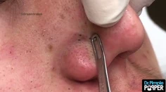 Videá vytláčania vyrážok sledujú milióny ľudí. Relaxujú pri tom