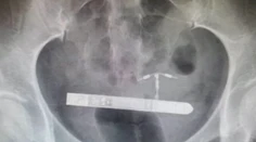 Pár si chcel spestriť romantické chvíle. Skončilo sa to bolestivými vibráciami v bruchu a operáciou