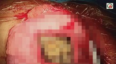 Zdesenie lekárov: Žene našli v žalúdku šperky a kovy v hodnote 60-tisíc eur