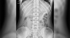 Výzva na sociálnej sieti dostala deti do nemocnice: Prehltli magnety, teraz bojujú o život