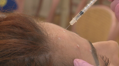 Botox je bežný už aj v dvadsiatke. Mladí sa čoraz viac obávajú vrások