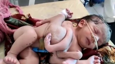 V Indii sa narodilo dievčatko so štyrmi nohami a tromi rukami. Pôvodne malo ísť o dvojičky