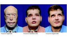 Plamene hasičovi znetvorili tvár, po 15 rokoch sa už môže usmievať
