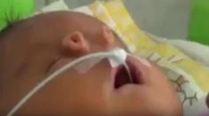 Novorodenec sa narodil bez nosa. Lekári však rodičov potešili