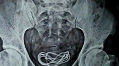 Muž prehltol nabíjačku na mobil. Keď lekár zistil, kam sa až dostala, zostal v šoku