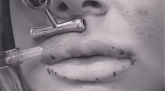 Má len 18 a už si nechala napichať pery. Dovolila jej to mama!