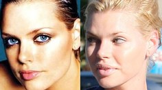 Krásna modelka to prehnala s plastikami. Vyzerá ako Joker z Batmana