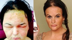 Poleptaná koža a hlava ako lopta. Tinu takmer zabila farba na vlasy!