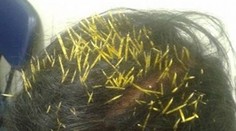 To muselo bolieť: Žene spadol na hlavu dikobraz