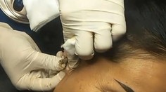 VIDEO: Lekár neveril vlastným očiam. Nenápadná vyrážka takmer poškodila žene ucho