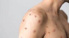 Po týždňoch obáv prišla prvá dobrá správa. Epidémia opičích kiahní v Európe sa spomaľuje