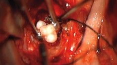 Zuby v nádore? Lekári ich našlii u štvormesačného bábätka