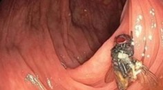 Nečakaný objav počas kolonoskopie: Do kamery zavedenej do čreva sa pozerala živá mucha