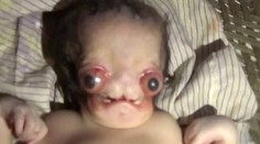 V Indii sa narodilo bábätko, ktoré vyzerá ako mimozemšťan. Matka sa ho nevzdá