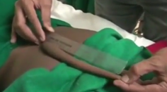 Indický tínedžer žil s 18-centimetrovým chvostom, teraz ho museli odrezať