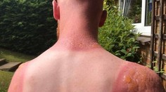 Záhradník si chcel zarobiť na dovolenku, skončil s popáleninami druhého stupňa