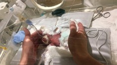 Chlapček vážil po narodení len 268 gramov, teraz tohto rekordéra prepustili z nemocnice