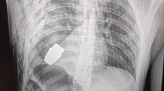 Riskantná operácia. Ukrajinskí chirurgovia vyoperovali z hrude vojaka nevybuchnutý granát