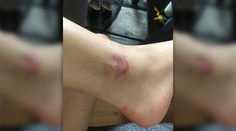 Bratislava opäť prehráva boj s komármi. Príchod daždivejších dní môže situáciu ešte zhoršiť