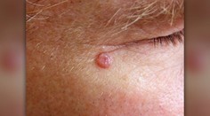 Máte malé škvrny na tvári? Nezanedbávajte vyšetrenie, doktor varuje pred stratou oka