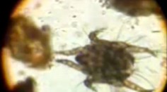 Personál nemocnice sa nakazil nepríjemným svrabom. Kto za to môže?