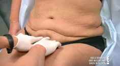 Plastika brucha jej zachránila život. Dopadla však príšerne