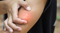 Čo robiť po útoku ôs, včiel či sršňov? Dôležitých je prvých desať minút