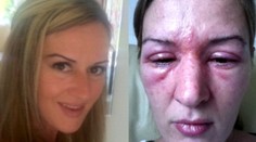 Umelé mihalnice vás môžu dohnať k slepote!