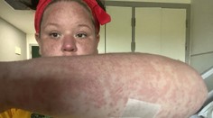 Ženu bodol na dovolenke nebezpečný hmyz. V reakcii s antibiotikami jej opadávali koža, vlasy aj nechty