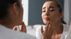 Trápi vás bolestivý opar? Vyliečte ho rýchlo potravinami z kuchyne