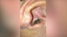 Video, z ktorého behá mráz po chrbte. Z mužovho ucha vyliezlo malé zvieratko