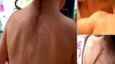 Deťom namiesto lieku na žalúdok podali prípravok na obnovu vlasov. Na tele im stále rastú chlpy