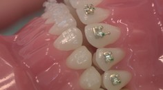 Doktorky sme sa pýtali, koľko poisťovne deťom prispievajú na zubné strojčeky