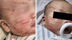 Mamička zostala zhrozená. Desaťtýždňové dieťa jej vrátili s poškriabanou tvárou