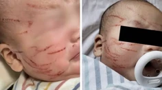Mamička zostala zhrozená. Desaťtýždňové dieťa jej vrátili s poškriabanou tvárou