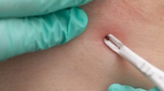 Na Slovensku tento rok evidujú vyše 180 prípadov kliešťovej encefalitídy. Riziko nepodceňujte ani na jeseň