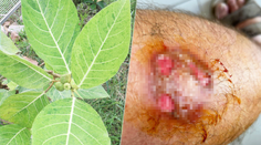 Vážne popáleniny mu spôsobila miazga zo známeho kríka. Pán Martin varuje aj ostatných záhradkárov