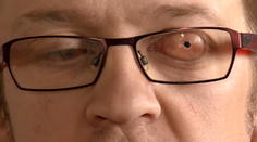 Unikátna operácia! Zrak mu vrátili pomocou zubu