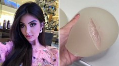 Podstúpila desiatky plastických operácií, teraz všetky ľutuje. Ženy odhovára aj od zväčšovania pŕs