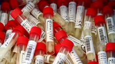 V pondelok potvrdili koronavírus 15 pacientom, hospitalizovaných je stále viac