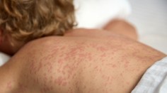 Na východe Slovenska potvrdili tri prípady osýpok