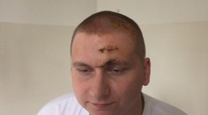 Liečili ho na zápal dutín, mal ale zápal mozgových blán: Úrad vydal ortieľ