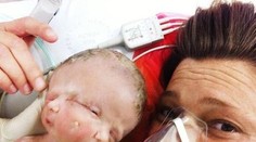 V Sydney sa narodili vzácne dvojčatá s jedným telom a dvoma tvárami