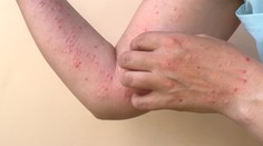 Laboratóriá potvrdili ďalšie dva prípady opičích kiahní