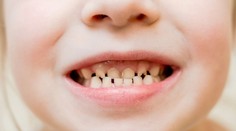 Viete kedy si umyť zuby a kedy sa kefke radšej vyhnúť? Odborníci odhalili správne techniky starostlivosti o chrup