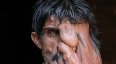 Ľudia sa ho desia a lekári mu nepomôžu: Ťažký osud "slonieho muža"