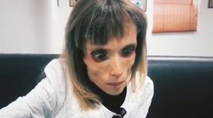 Anorektička (26) vyzerá ako z hororu. Váži iba 17 kilogramov