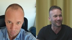 Roman podstúpil vlasovú transplantáciu. Popísal, ako to celé prebiehalo